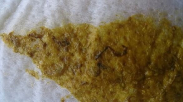 viermi în fecale la un copil